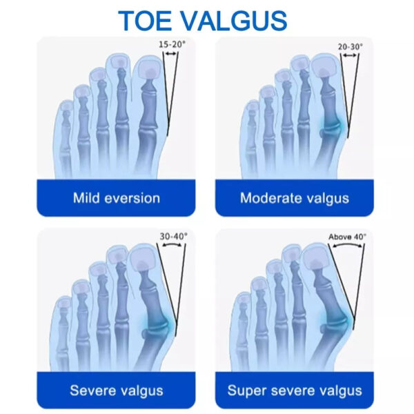 Bunion Fix Corrector - Image 3